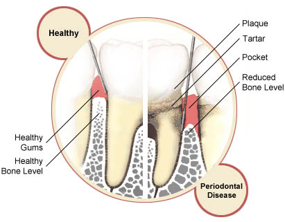 Illustration comparing healthy gums to those with periodontal disease
